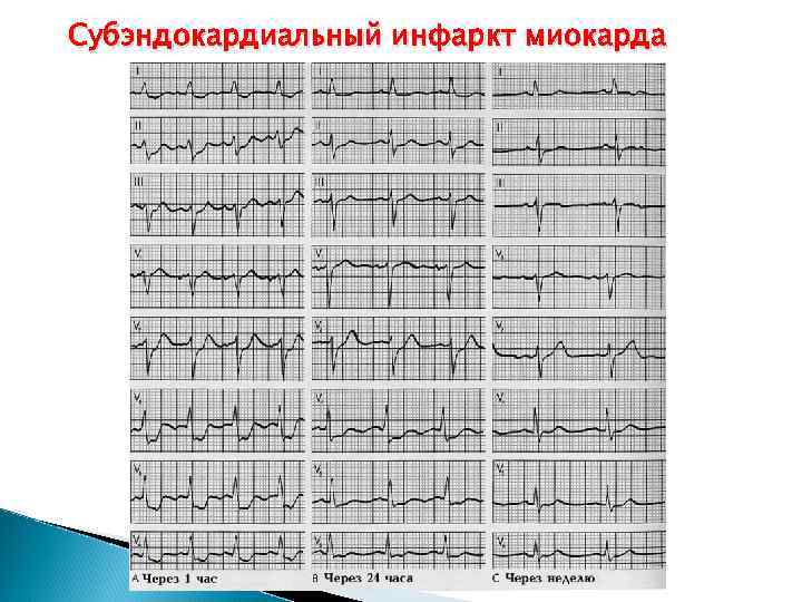 Повреждение миокарда на экг что это