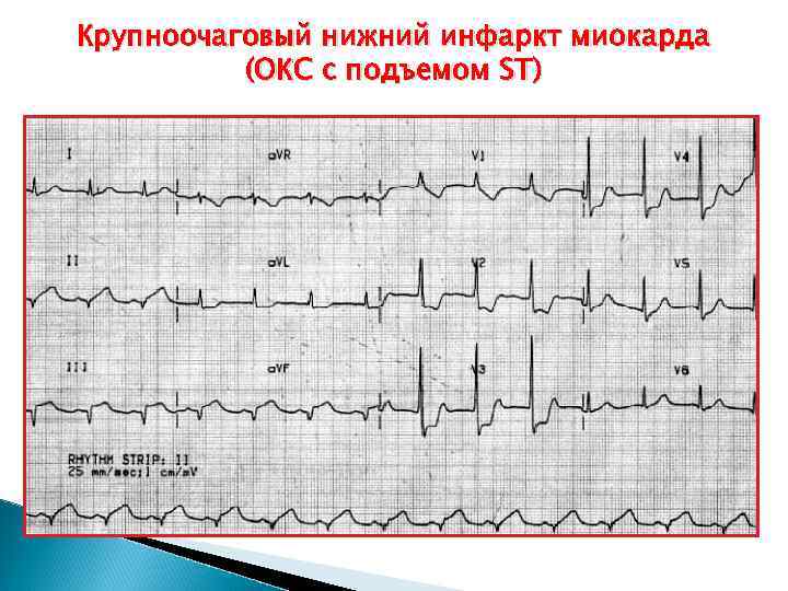 Без подъема st на экг. ЭКГ острый инфаркт миокарда с подъемом St. Инфаркт с подъемом ст на ЭКГ. Инфаркт с подъемом сегмента St ЭКГ. ОИМ С подъемом St ЭКГ.