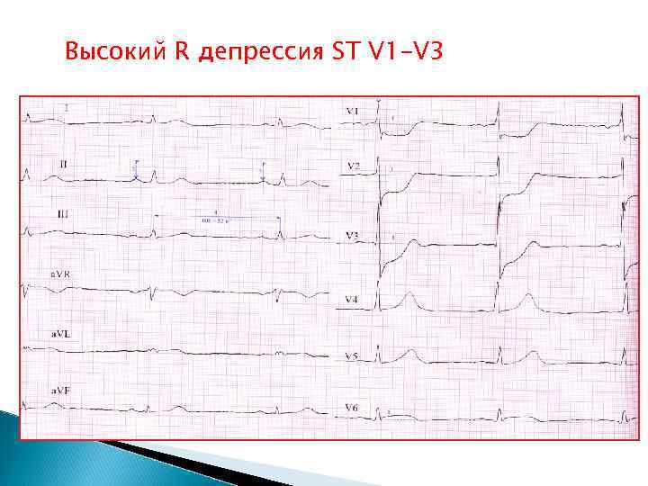 Высокий R депрессия ST V 1 -V 3 