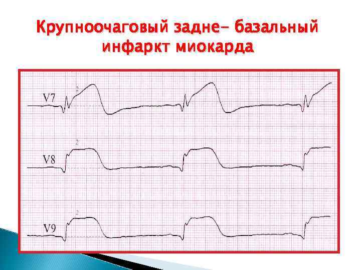 Крупноочаговый задне- базальный инфаркт миокарда 