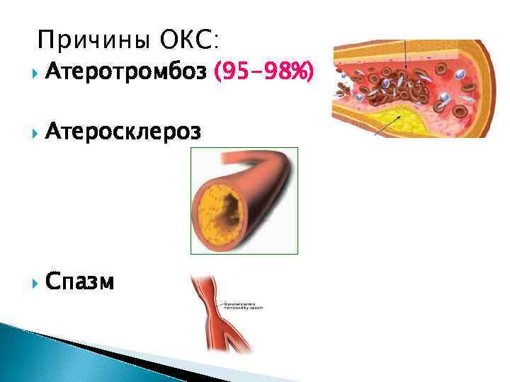 Причины ОКС: Атеротромбоз (95 -98%) Атеросклероз Спазм 