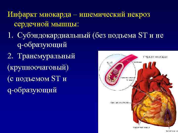 Инфаркт миокарда – ишемический некроз сердечной мышцы: 1. Субэндокардиальный (без подъема ST и не