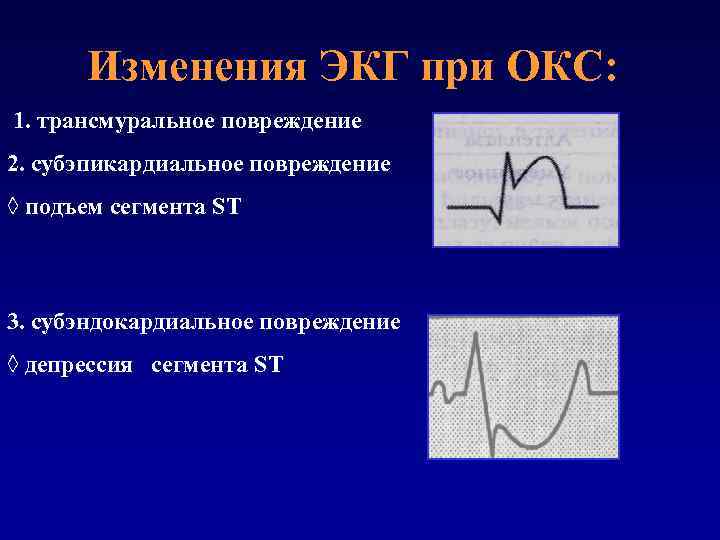 Изменения ЭКГ при ОКС: 1. трансмуральное повреждение 2. субэпикардиальное повреждение ◊ подъем сегмента ST