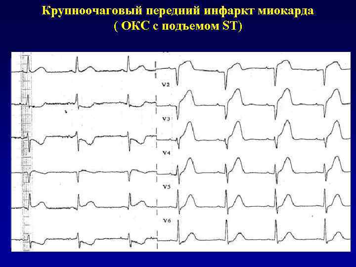 Крупноочаговый передний инфаркт миокарда ( ОКС с подъемом ST) 