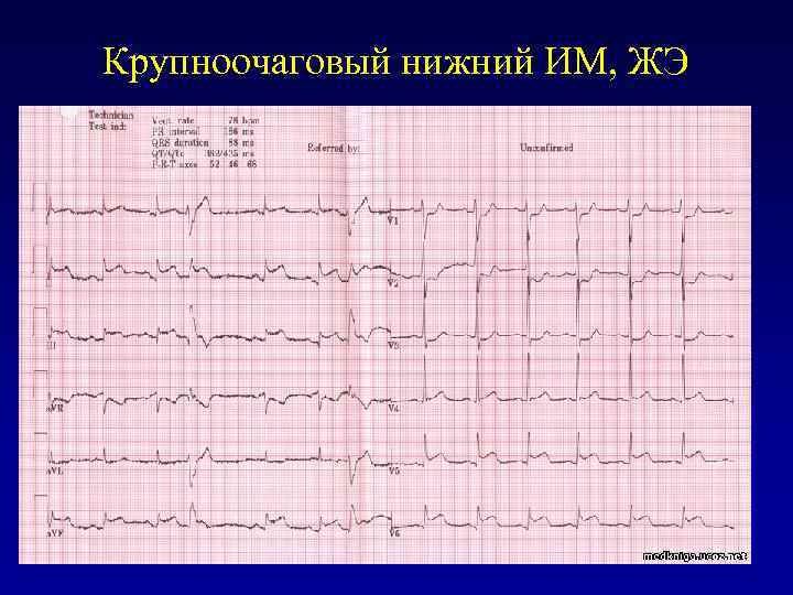 Крупноочаговый нижний ИМ, ЖЭ 