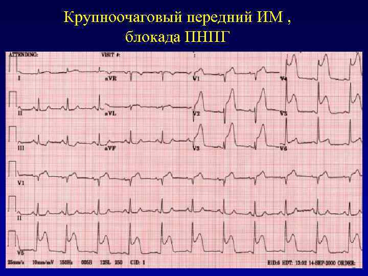 Крупноочаговый передний ИМ , блокада ПНПГ 