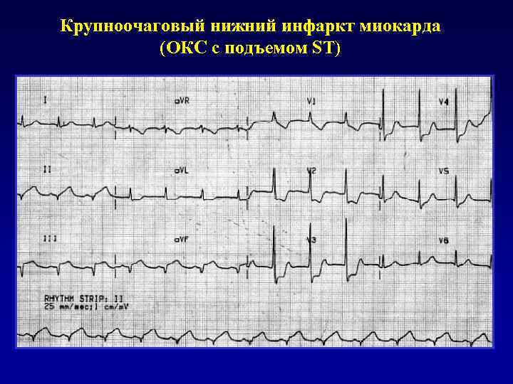 Крупноочаговый нижний инфаркт миокарда (ОКС с подъемом ST) 