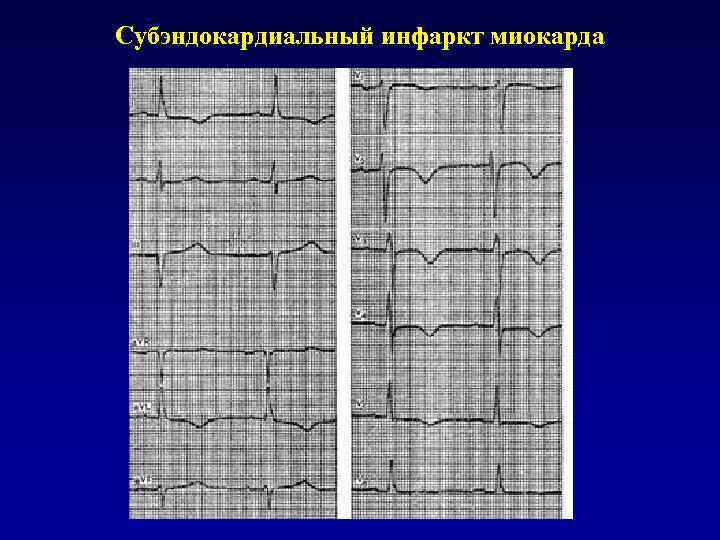 Субэпикардиальная ишемия нижней стенки