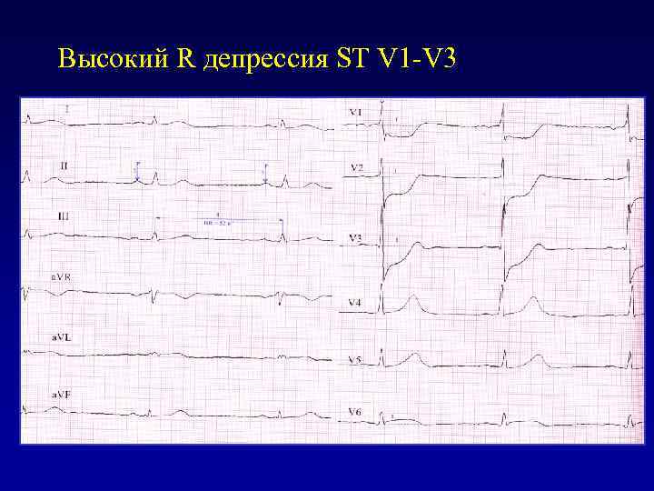 Высокий R депрессия ST V 1 -V 3 