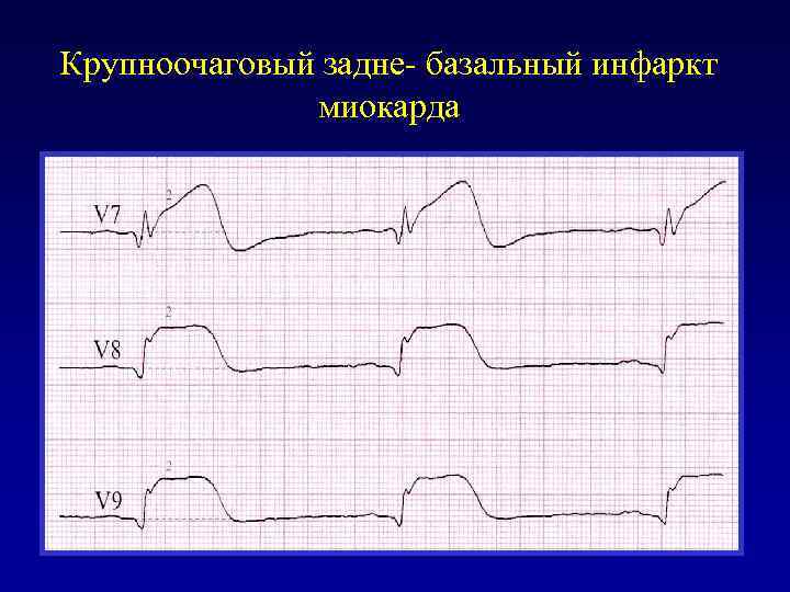 Крупноочаговый задне- базальный инфаркт миокарда 