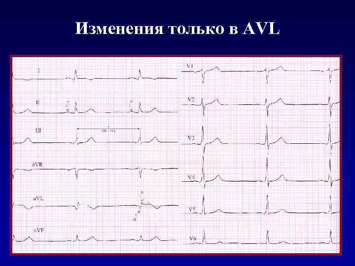 Изменения только в AVL 