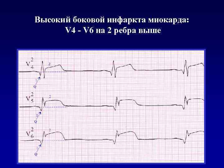 Высокий боковой