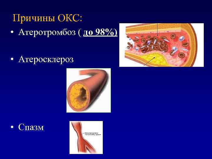 Причины ОКС: • Атеротромбоз ( до 98%) • Атеросклероз • Спазм 