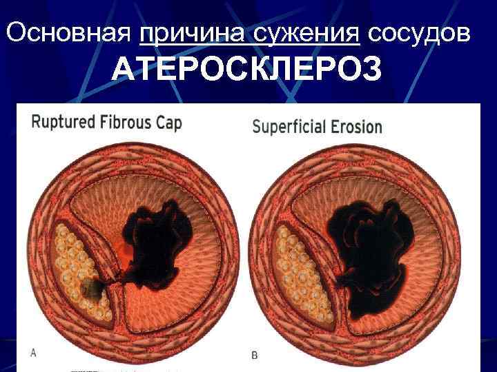 Основная причина сужения сосудов АТЕРОСКЛЕРОЗ 