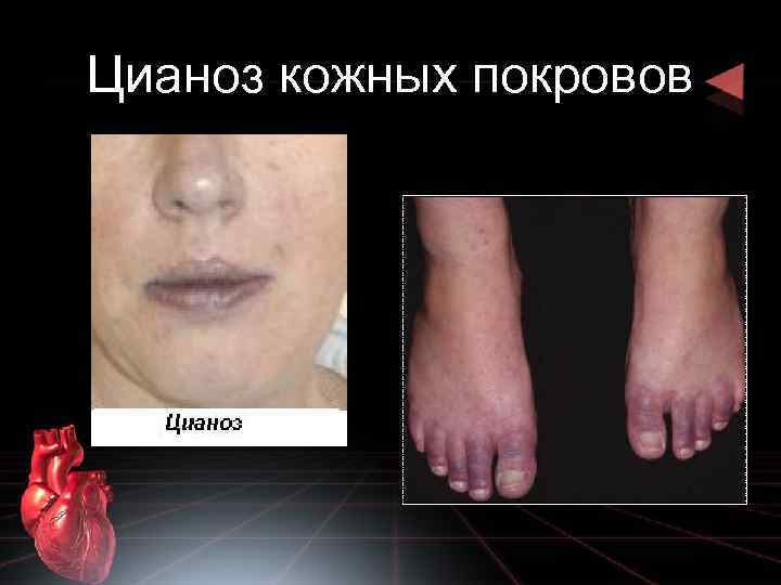 Цианоз кожных покровов 