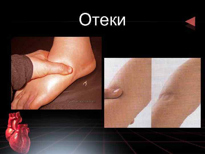 Отеки 
