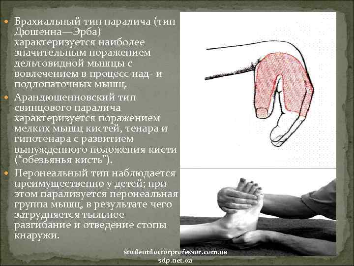  Брахиальный тип паралича (тип Дюшенна—Эрба) характеризуется наиболее значительным поражением дельтовидной мышцы с вовлечением