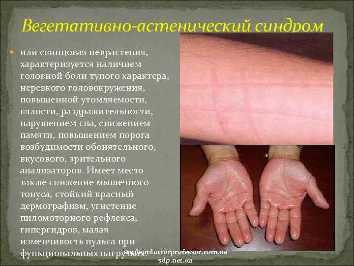 Вегетативно-астенический синдром или свинцовая неврастения, характеризуется наличием головной боли тупого характера, нерезкого головокружения, повышенной