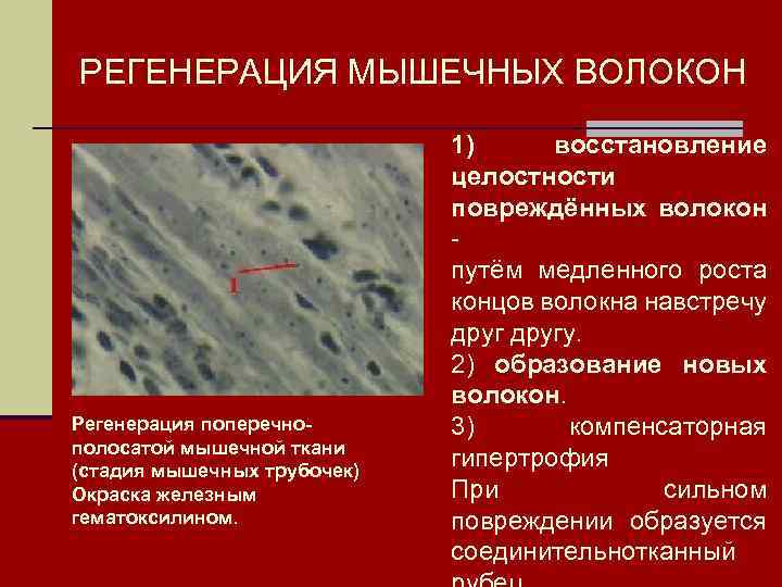 РЕГЕНЕРАЦИЯ МЫШЕЧНЫХ ВОЛОКОН Регенерация поперечнополосатой мышечной ткани (стадия мышечных трубочек) Окраска железным гематоксилином. 1)