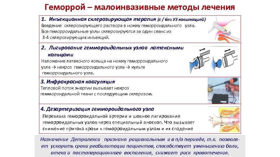 Время лечения геморроя. Малоинвазивные методы лечения геморроя. Малоинвазивная методика при геморрое. Алгоритм лечения геморроя. Дезартеризация геморроидальных узлов методика.