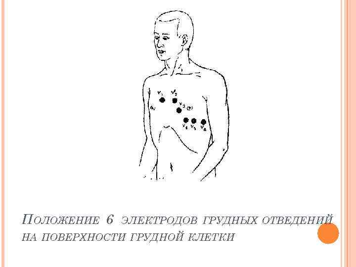 Схема установки электродов холтера