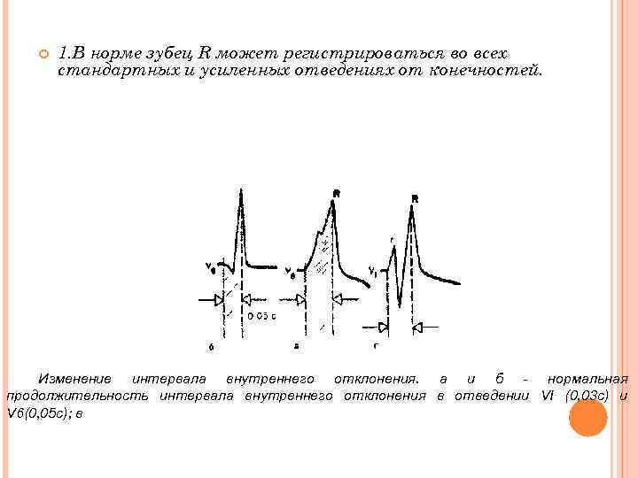  1. В норме зубец R может регистрироваться во всех стандартных и усиленных отведениях