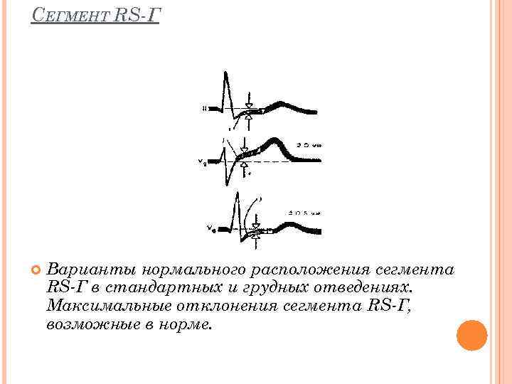 СЕГМЕНТ RS Г Варианты нормального расположения сегмента RS Г в стандартных и грудных отведениях.