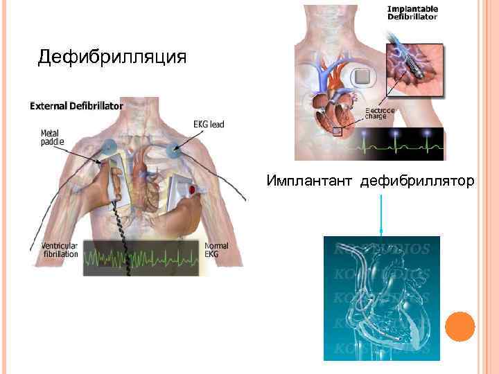 Дефибрилляция Имплантант дефибриллятор 