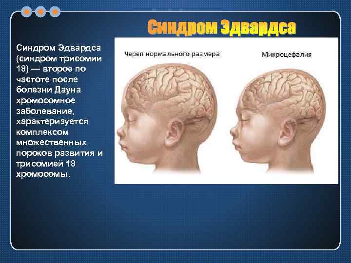 Синдром Эдвардса (синдром трисомии 18) — второе по частоте после болезни Дауна хромосомное заболевание,