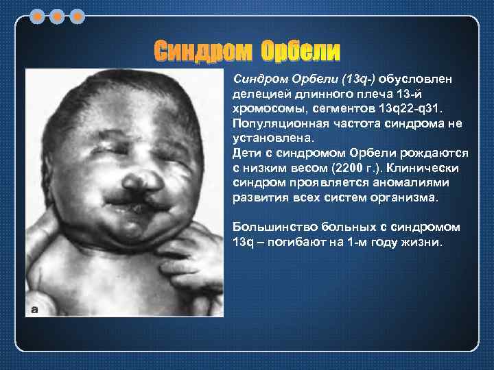 Синдром Орбели (13 q-) обусловлен делецией длинного плеча 13 -й хромосомы, сегментов 13 q