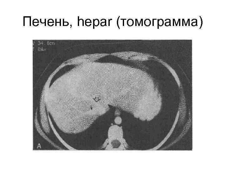 Печень, hepar (томограмма) 