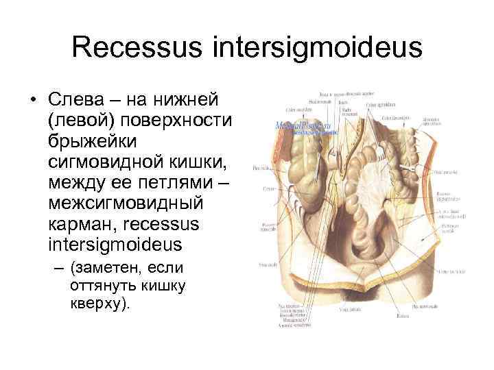 Recessus intersigmoideus • Слева – на нижней (левой) поверхности брыжейки сигмовидной кишки, между ее