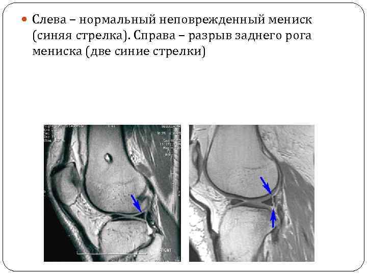 Операция заднего рога мениска