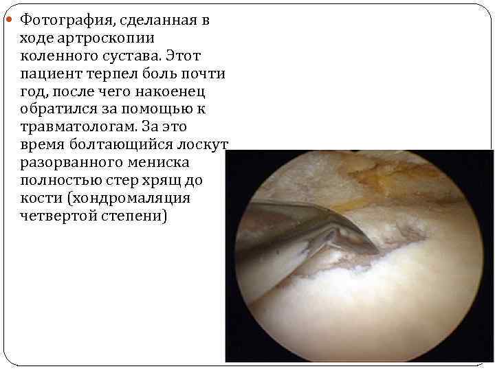  Фотография, сделанная в ходе артроскопии коленного сустава. Этот пациент терпел боль почти год,