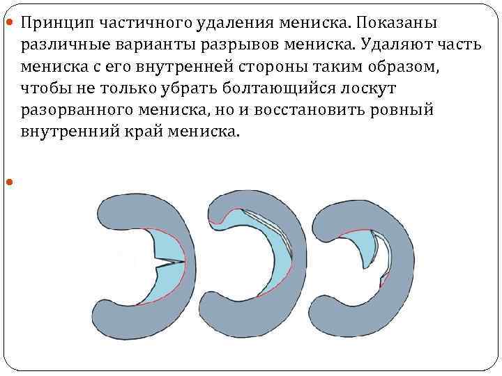 Горизонтальный разрыв. Разрыв мениска варианты. Разрыв медиального мениска удаленный.