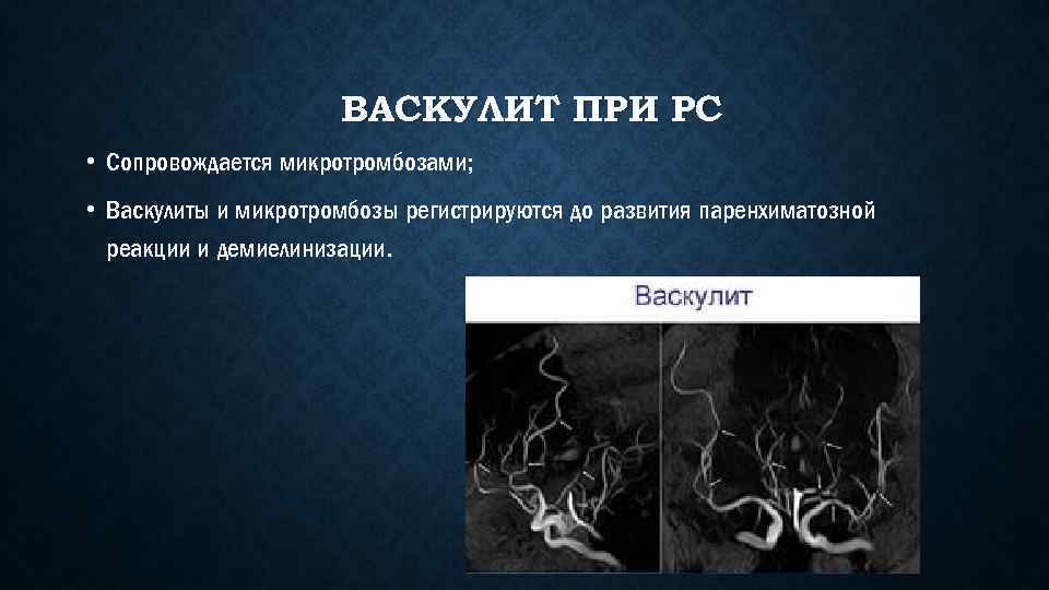 ВАСКУЛИТ ПРИ РС • Сопровождается микротромбозами; • Васкулиты и микротромбозы регистрируются до развития паренхиматозной