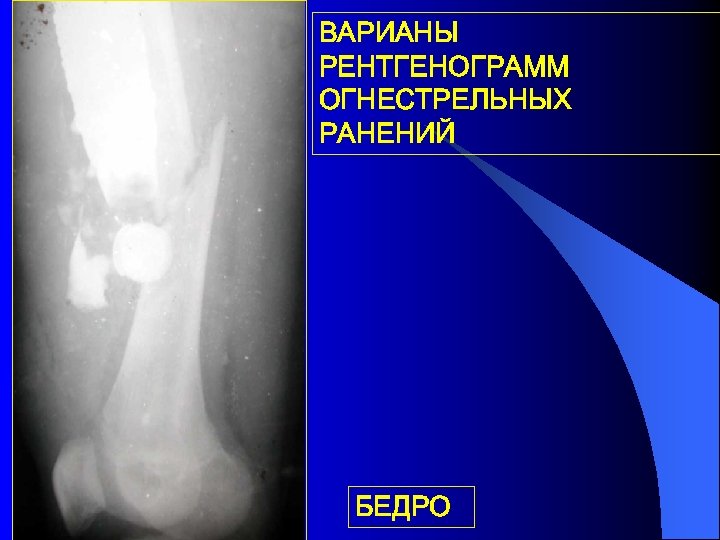 ВАРИАНЫ РЕНТГЕНОГРАММ ОГНЕСТРЕЛЬНЫХ РАНЕНИЙ БЕДРО 