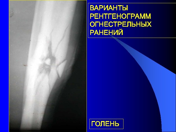 Травматология огнестрельные ранения презентация