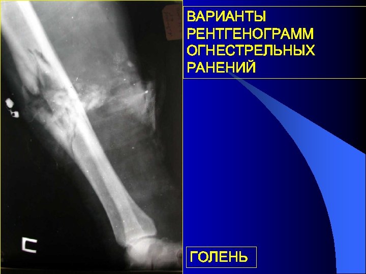 ВАРИАНТЫ РЕНТГЕНОГРАММ ОГНЕСТРЕЛЬНЫХ РАНЕНИЙ ГОЛЕНЬ 