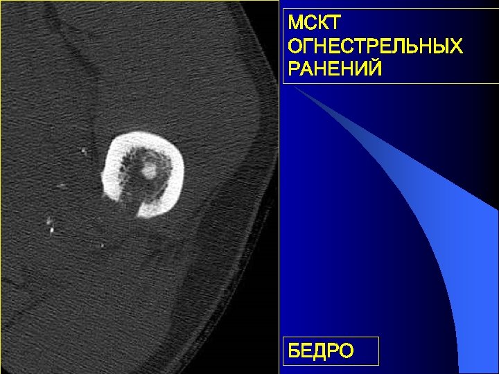 МСКТ ОГНЕСТРЕЛЬНЫХ РАНЕНИЙ БЕДРО 