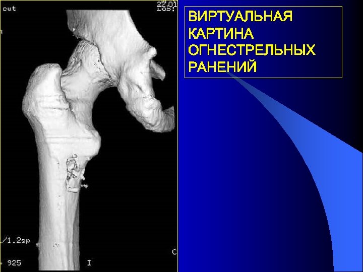 ВИРТУАЛЬНАЯ КАРТИНА ОГНЕСТРЕЛЬНЫХ РАНЕНИЙ 