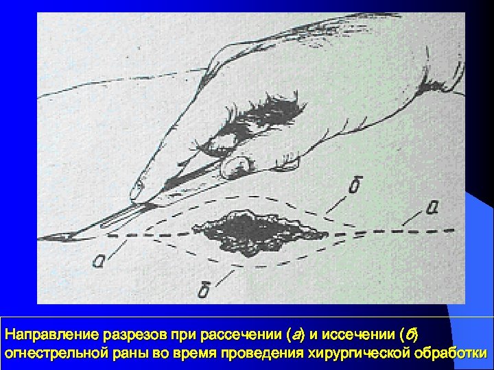 Направление разрезов при рассечении (а) и иссечении (б) огнестрельной раны во время проведения хирургической