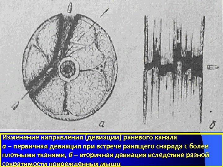 Изменение направления (девиации) раневого канала а – первичная девиация при встрече ранящего снаряда с