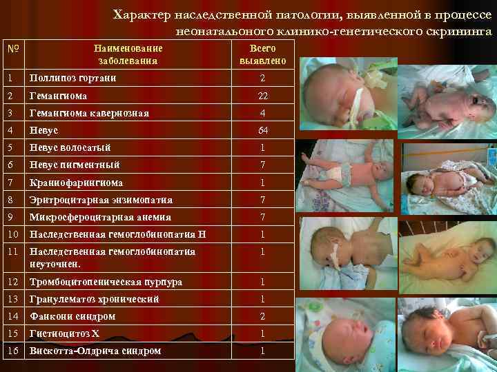 Характер наследственной патологии, выявленной в процессе неонатальоного клинико-генетического скрининга № Наименование заболевания Всего выявлено