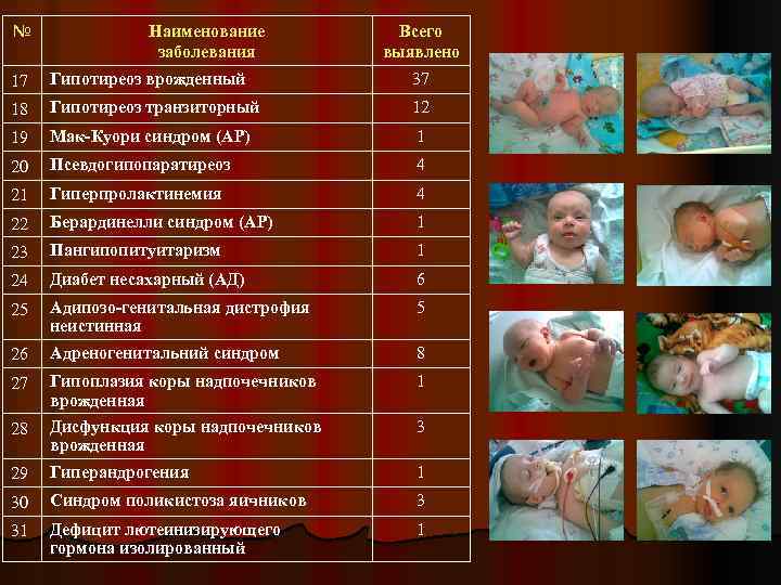№ Наименование заболевания Всего выявлено 17 Гипотиреоз врожденный 37 18 Гипотиреоз транзиторный 12 19