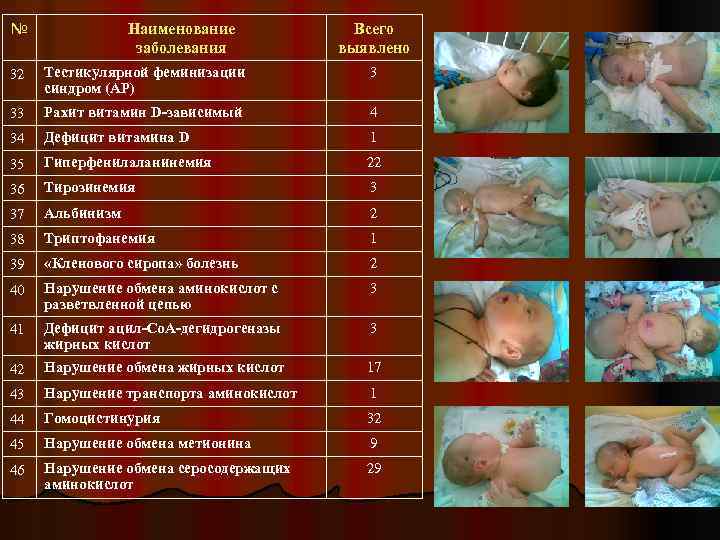 № Наименование заболевания Всего выявлено 32 Тестикулярной феминизации синдром (АР) 3 33 Рахит витамин
