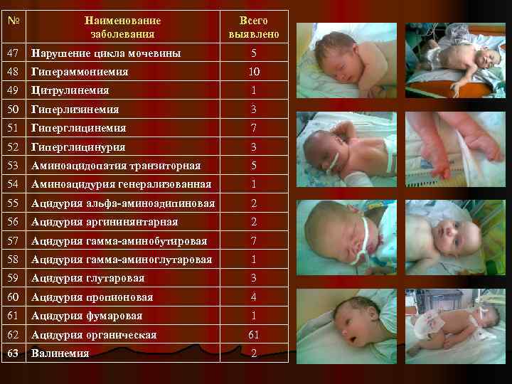 № Наименование заболевания Всего выявлено 47 Нарушение цикла мочевины 5 48 Гипераммониемия 10 49