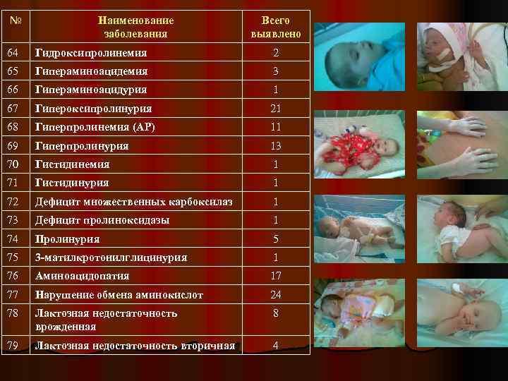 № Наименование заболевания Всего выявлено 64 Гидроксипролинемия 2 65 Гипераминоацидемия 3 66 Гипераминоацидурия 1