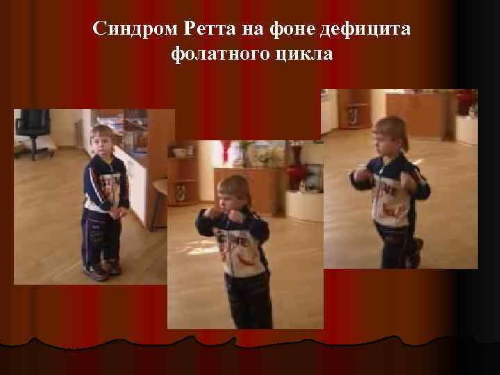Синдром Ретта на фоне дефицита фолатного цикла 