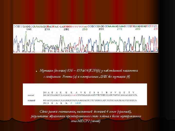 . Мутация (делеция) 856 – 859 de 14(K 286 fs) у наблюдаемой пациентки с